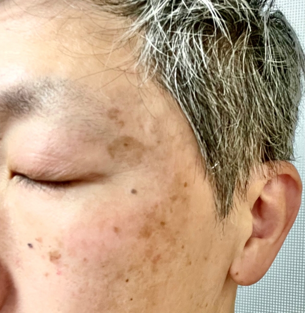 おっさんの肌のシミがあるイメージ画